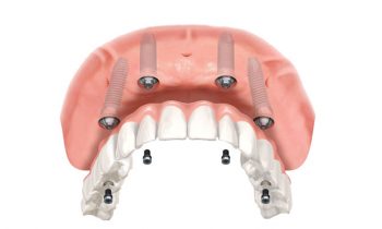 Prótese Dentaria