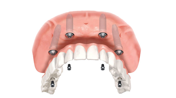 Prótese Dentária - Vila do Sorriso
